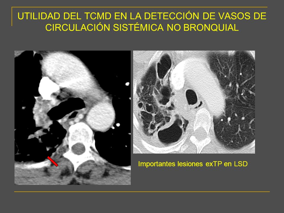 UTILIDAD DEL TCMD EN LA DETECCIÓN DE VASOS DE CIRCULACIÓN SISTÉMICA NO BRONQUIAL