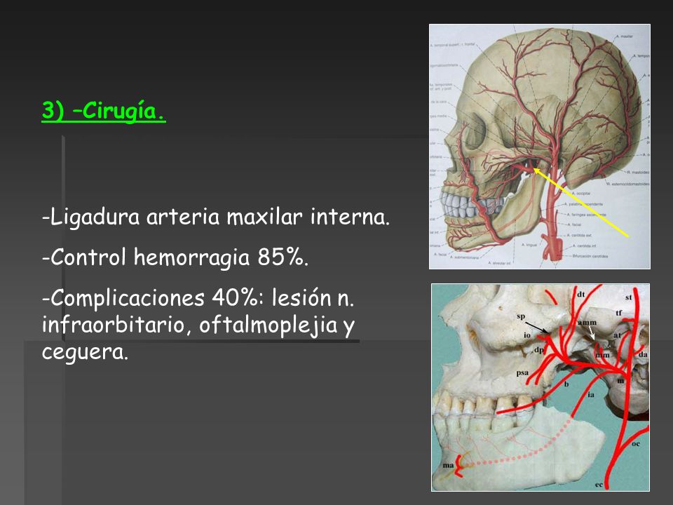 3) –Cirugía. Ligadura arteria maxilar interna. Control hemorragia 85%.