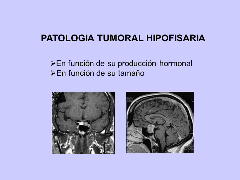 PATOLOGIA TUMORAL HIPOFISARIA