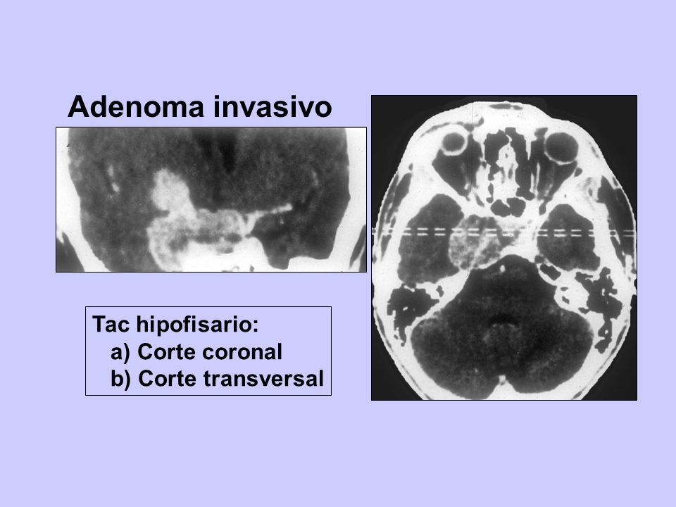 Adenoma invasivo Tac hipofisario: a) Corte coronal