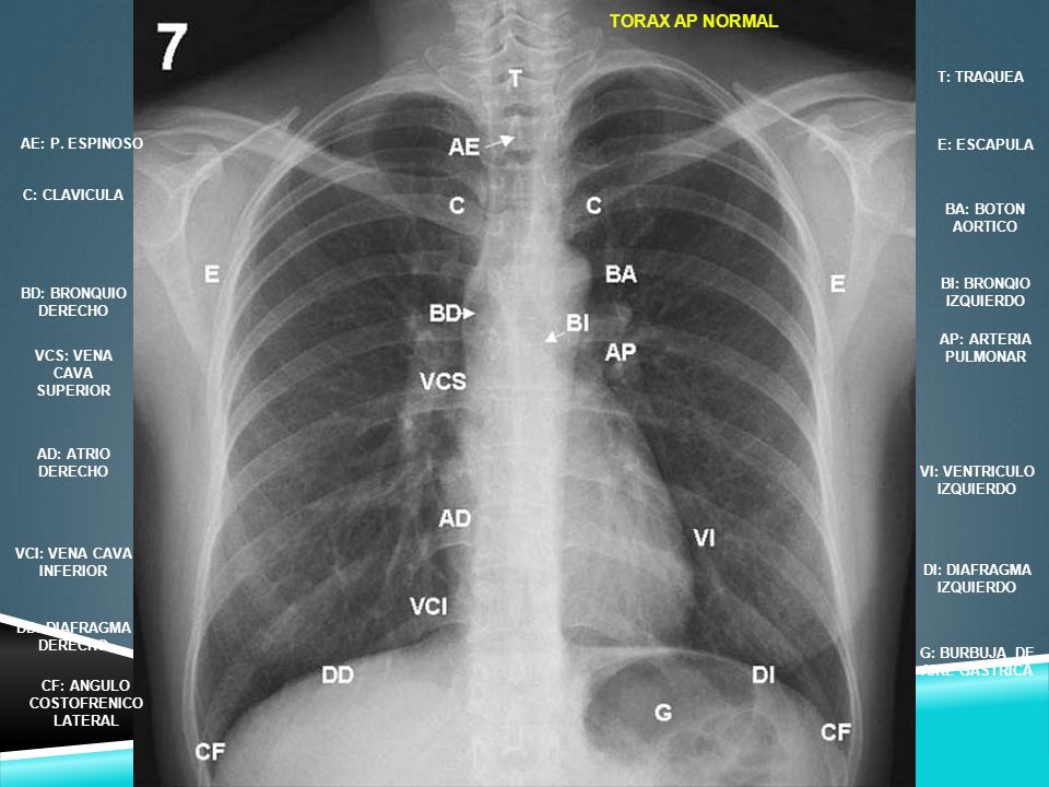 TORAX AP NORMAL T: TRAQUEA AE: P. ESPINOSO E: ESCAPULA C: CLAVICULA