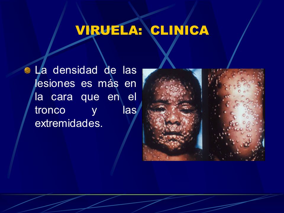 VIRUELA: CLINICA La densidad de las lesiones es más en la cara que en el tronco y las extremidades.