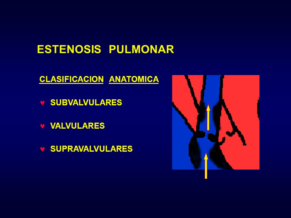 ESTENOSIS PULMONAR CLASIFICACION ANATOMICA SUBVALVULARES VALVULARES
