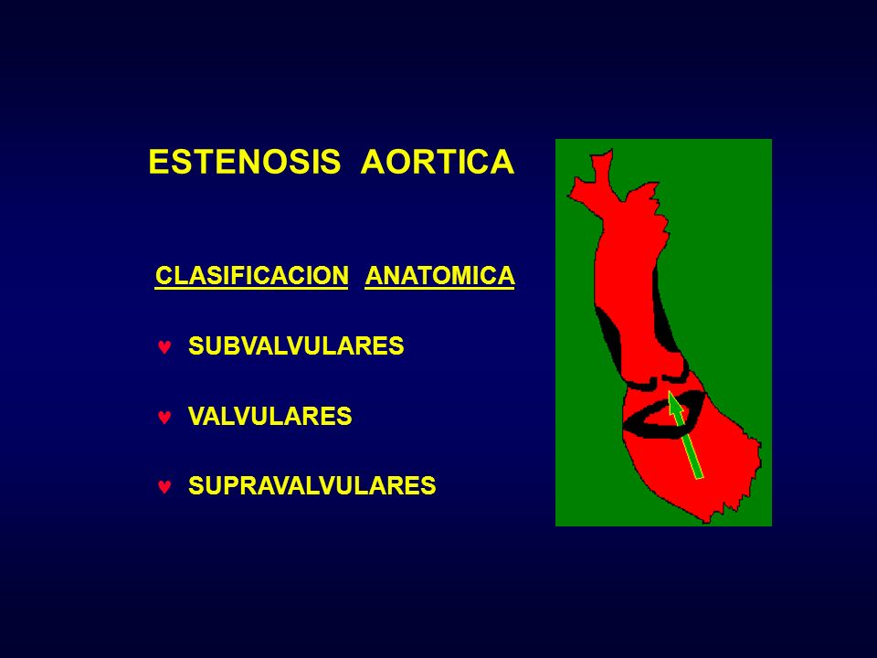 ESTENOSIS AORTICA CLASIFICACION ANATOMICA SUBVALVULARES VALVULARES