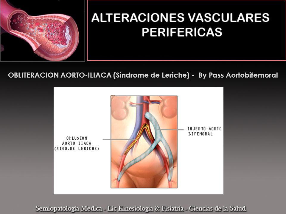 OBLITERACION AORTO-ILIACA (Síndrome de Leriche) - By Pass Aortobifemoral
