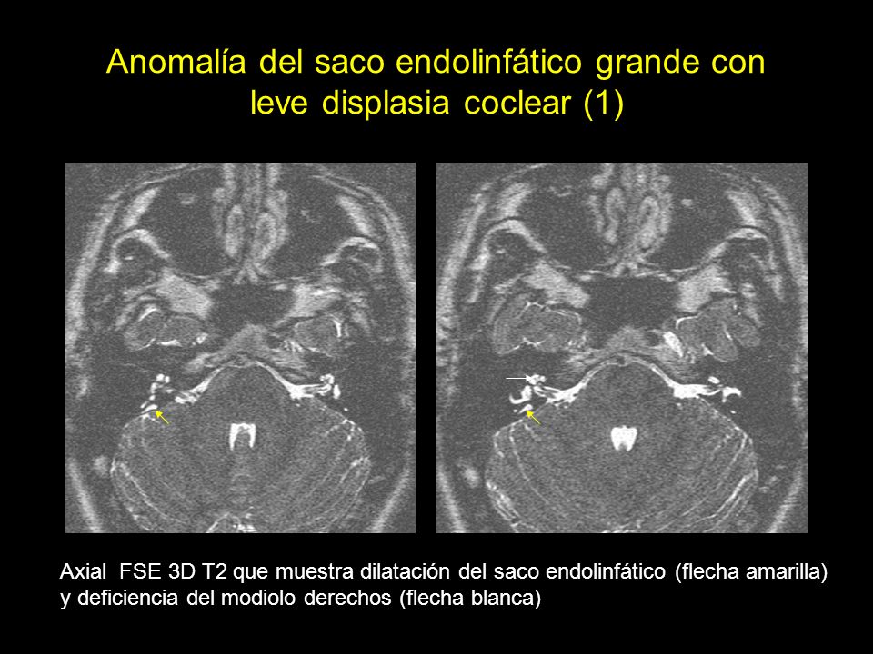 Anomalía del saco endolinfático grande con leve displasia coclear (1)