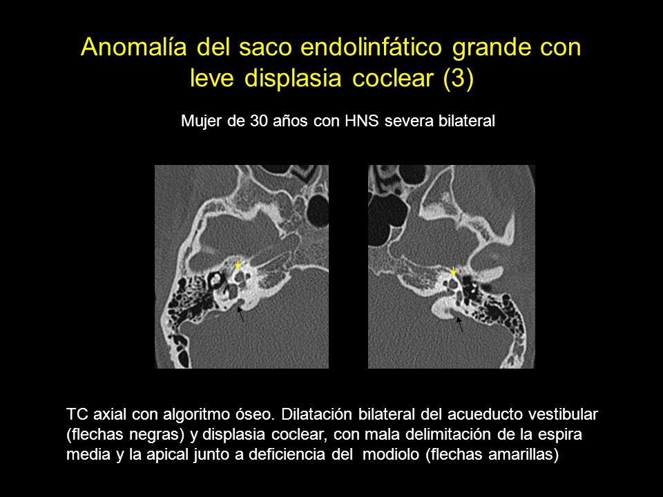 Anomalía del saco endolinfático grande con leve displasia coclear (3)