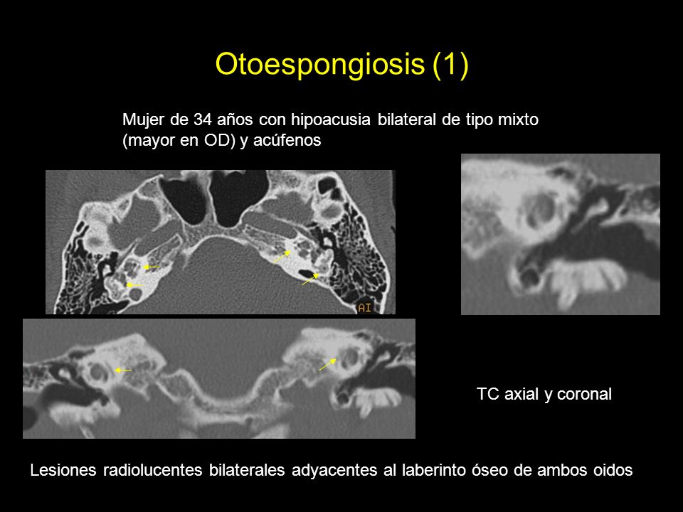 Otoespongiosis (1) Mujer de 34 años con hipoacusia bilateral de tipo mixto. (mayor en OD) y acúfenos.
