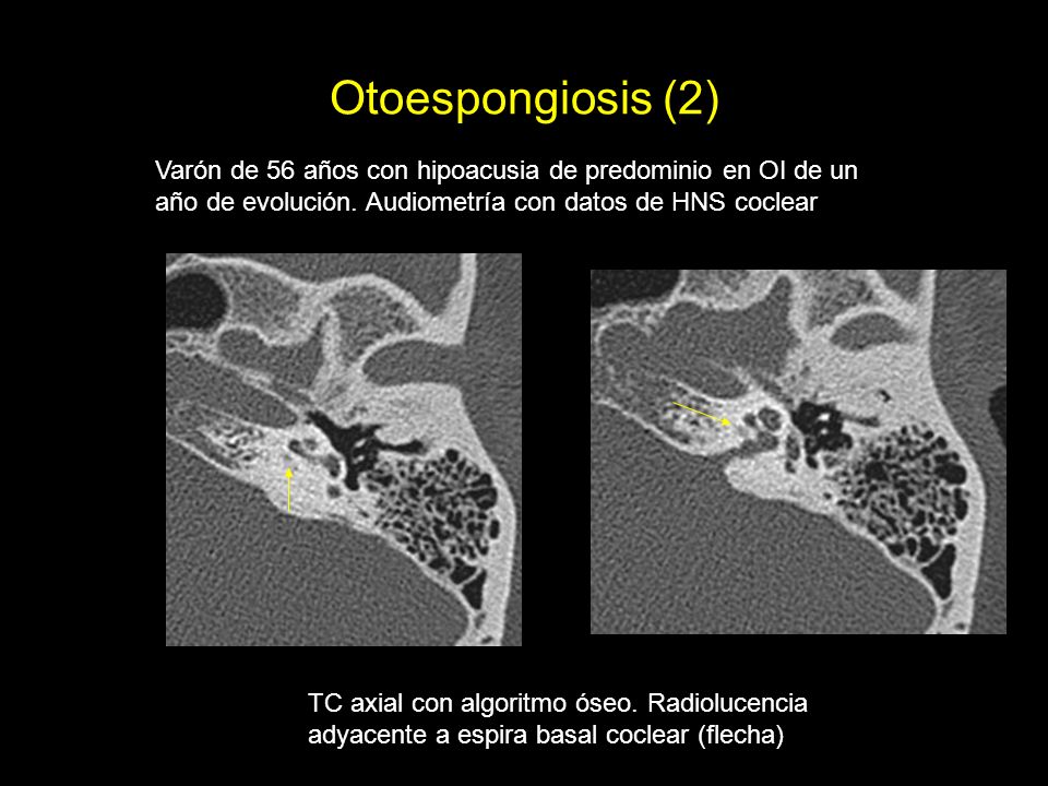 Otoespongiosis (2) Varón de 56 años con hipoacusia de predominio en OI de un año de evolución. Audiometría con datos de HNS coclear.