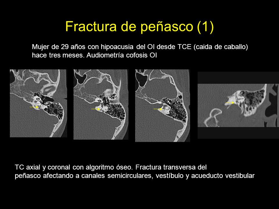Fractura de peñasco (1) Mujer de 29 años con hipoacusia del OI desde TCE (caida de caballo) hace tres meses. Audiometría cofosis OI.
