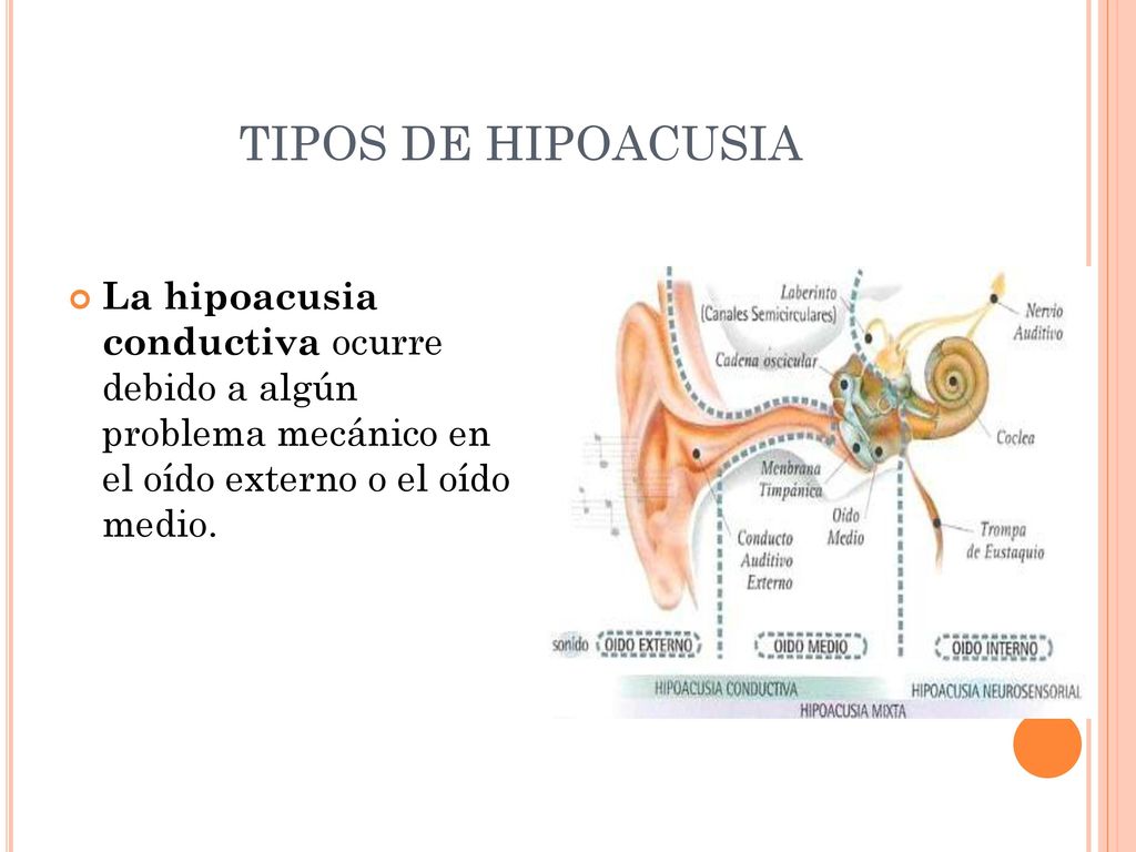 TIPOS DE HIPOACUSIA La hipoacusia conductiva ocurre debido a algún problema mecánico en el oído externo o el oído medio.