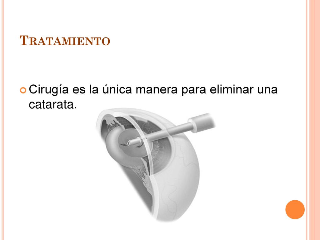 Tratamiento Cirugía es la única manera para eliminar una catarata.