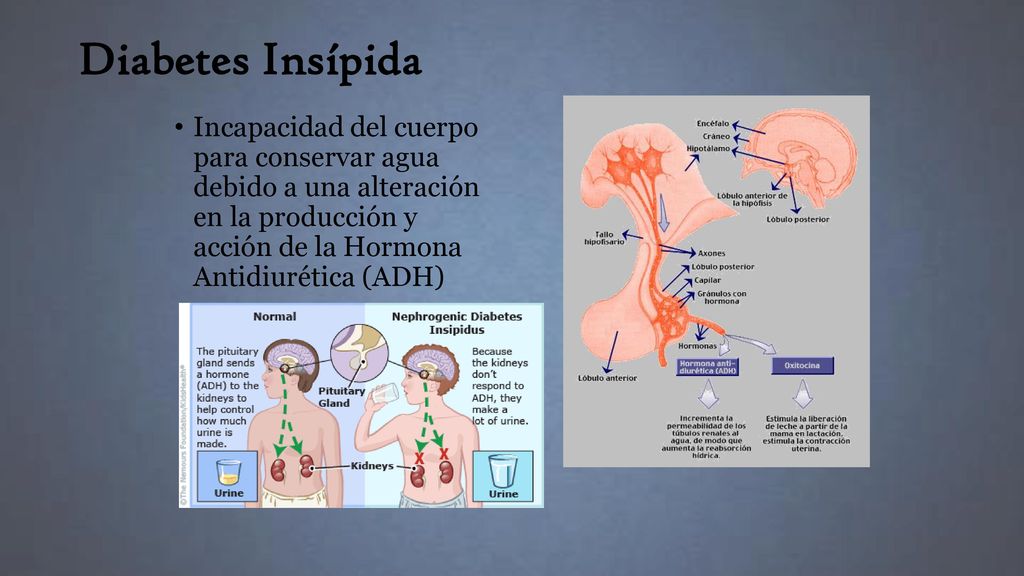 Diabetes Insípida Incapacidad del cuerpo para conservar agua debido a una alteración en la producción y acción de la Hormona Antidiurética (ADH)
