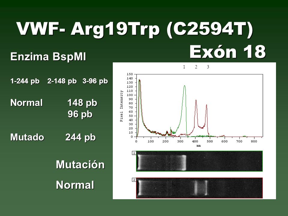 VWF- Arg19Trp (C2594T) Exón 18 Enzima BspMI Mutación Normal