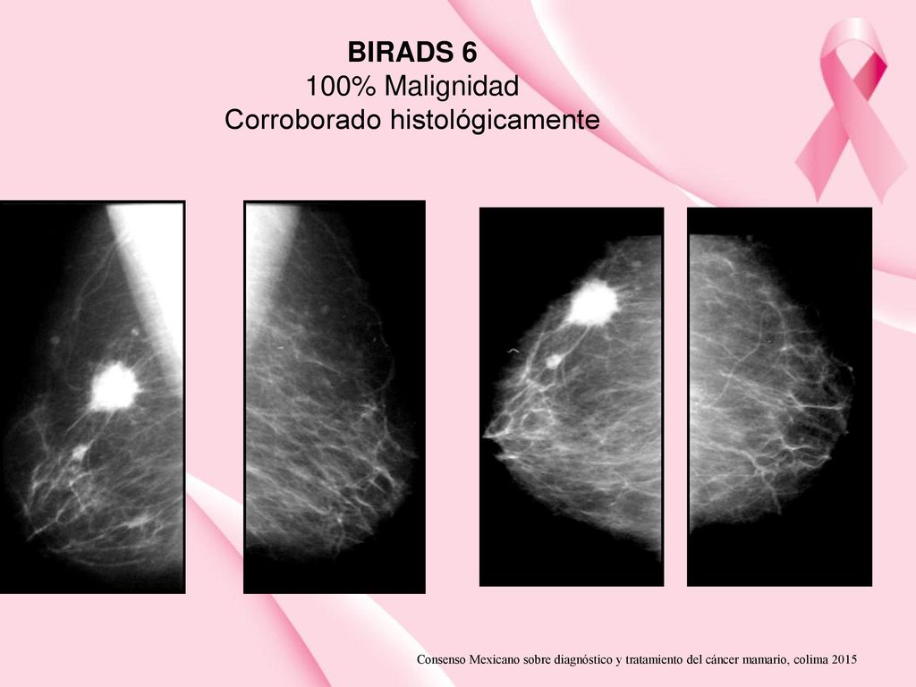 Bi rads 4a молочной. Маммография бирадс. Классификация birads маммография. Birads 6. Birads молочной железы.