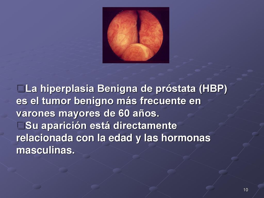 La hiperplasia Benigna de próstata (HBP) es el tumor benigno más frecuente en varones mayores de 60 años.