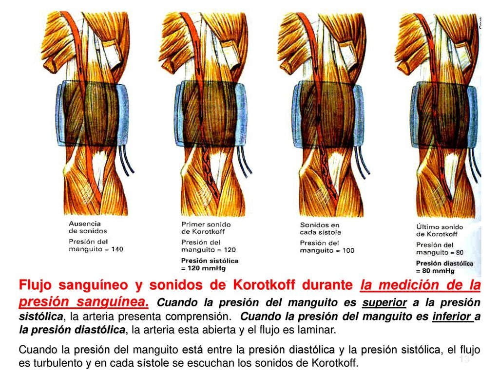 Flujo sanguíneo y sonidos de Korotkoff durante la medición de la presión sanguínea. Cuando la presión del manguito es superior a la presión sistólica, la arteria presenta comprensión. Cuando la presión del manguito es inferior a la presión diastólica, la arteria esta abierta y el flujo es laminar.