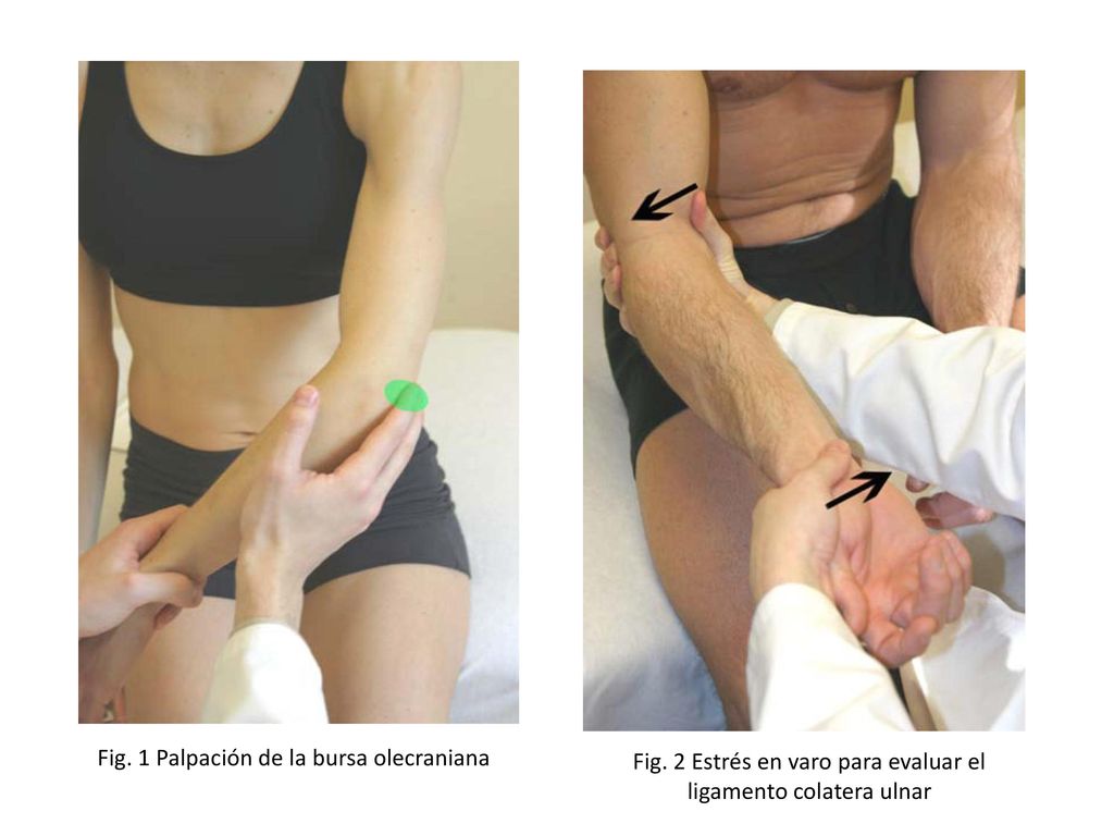 Fig. 2 Estrés en varo para evaluar el ligamento colatera ulnar