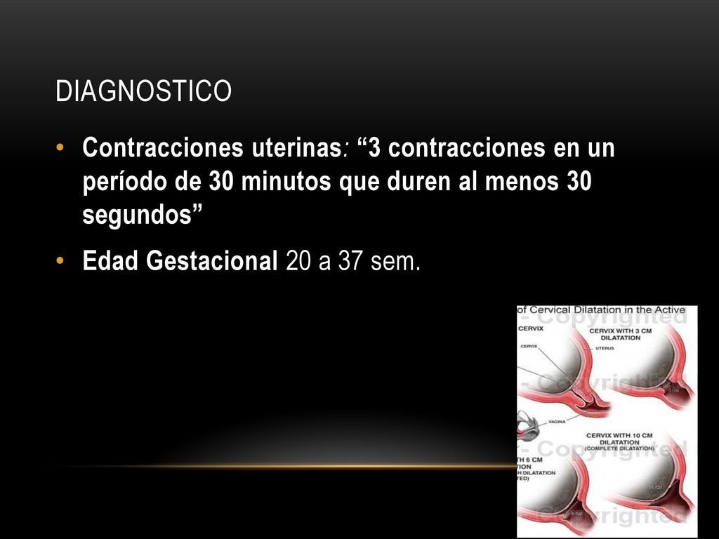 DIAGNOSTICO Contracciones uterinas: 3 contracciones en un período de 30 minutos que duren al menos 30 segundos