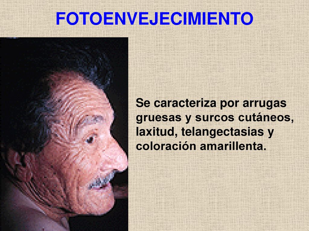 FOTOENVEJECIMIENTO Se caracteriza por arrugas gruesas y surcos cutáneos, laxitud, telangectasias y coloración amarillenta.