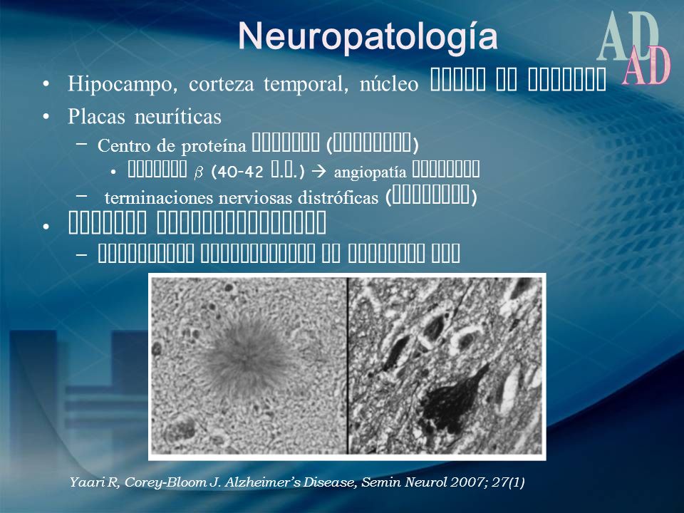 Neuropatología AD Hipocampo, corteza temporal, núcleo basal de Meynert