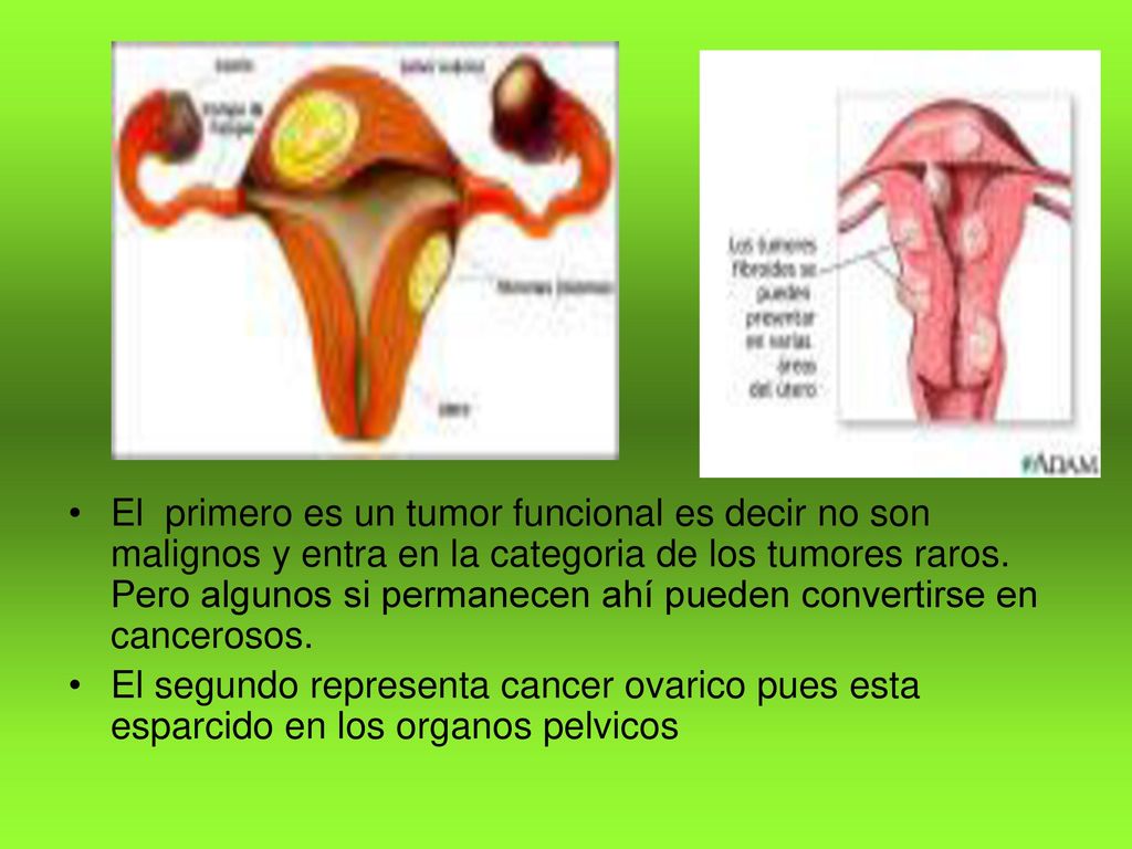 El primero es un tumor funcional es decir no son malignos y entra en la categoria de los tumores raros. Pero algunos si permanecen ahí pueden convertirse en cancerosos.