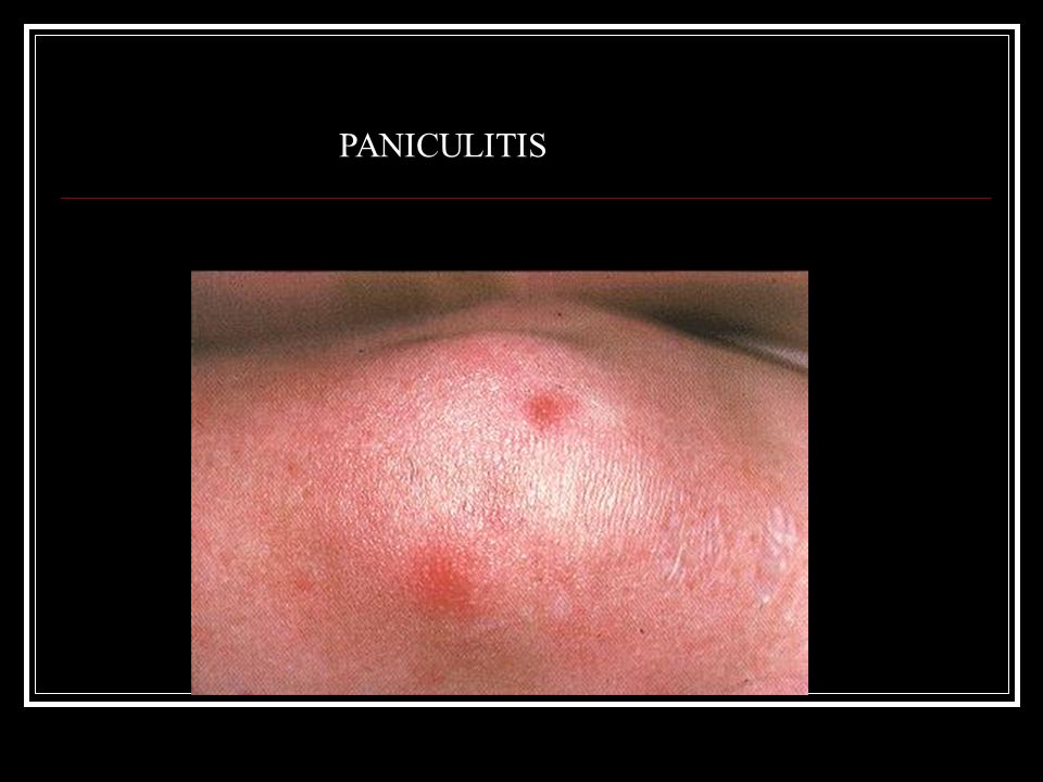 PANICULITIS