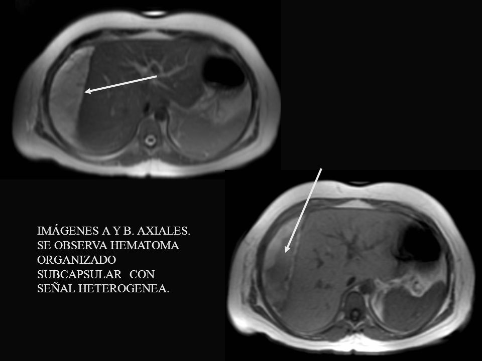 IMÁGENES A Y B. AXIALES. SE OBSERVA HEMATOMA ORGANIZADO SUBCAPSULAR CON SEÑAL HETEROGENEA.