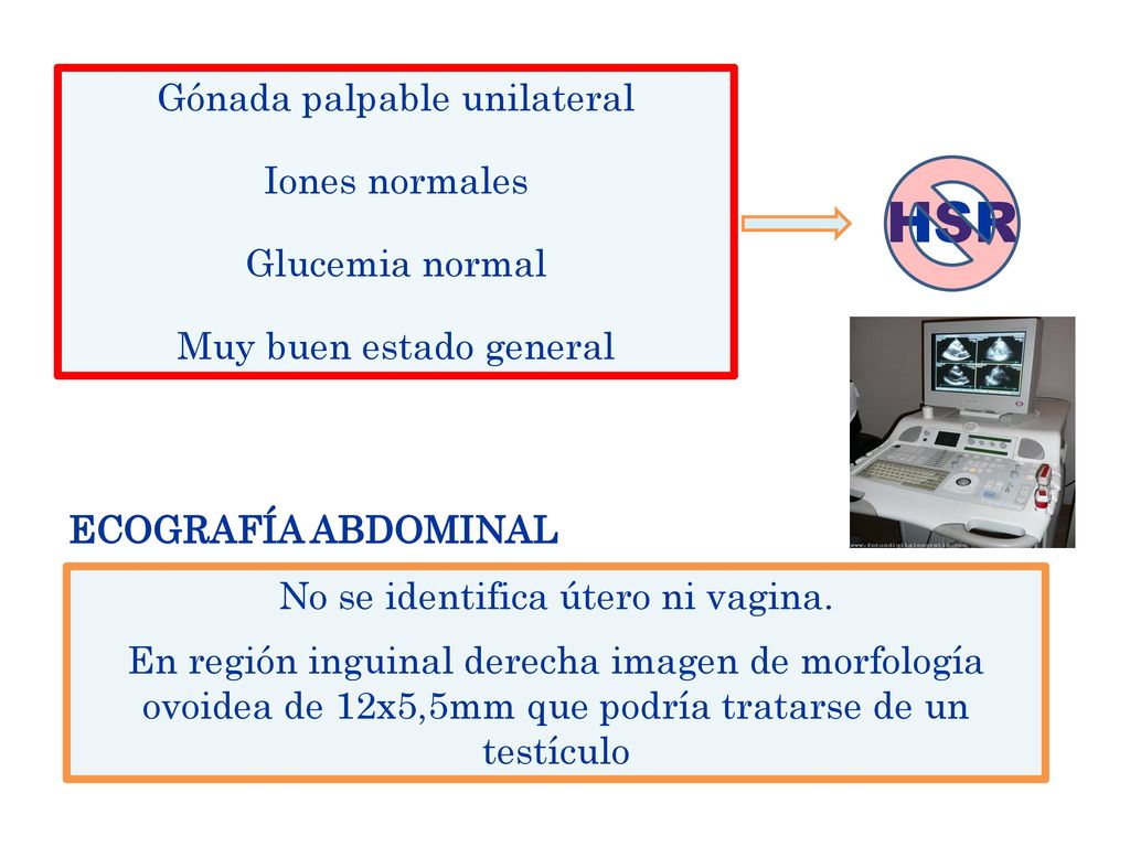 HSR Gónada palpable unilateral Iones normales Glucemia normal