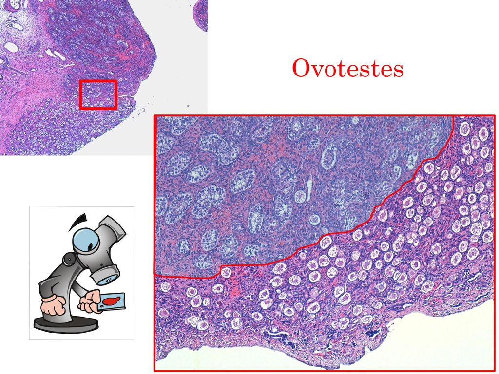 Ovotestes Tejido testicular (túbulos seminíferos inmaduros) y tejido ovárico (folículos primordiales).