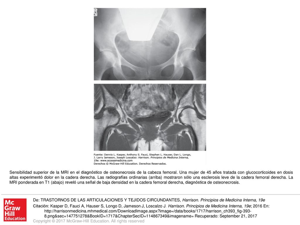 Sensibilidad superior de la MRI en el diagnóstico de osteonecrosis de la cabeza femoral. Una mujer de 45 años tratada con glucocorticoides en dosis altas experimentó dolor en la cadera derecha. Las radiografías ordinarias (arriba) mostraron sólo una esclerosis leve de la cadera femoral derecha. La MRI ponderada en T1 (abajo) reveló una señal de baja densidad en la cadera femoral derecha, diagnóstica de osteonecrosis.