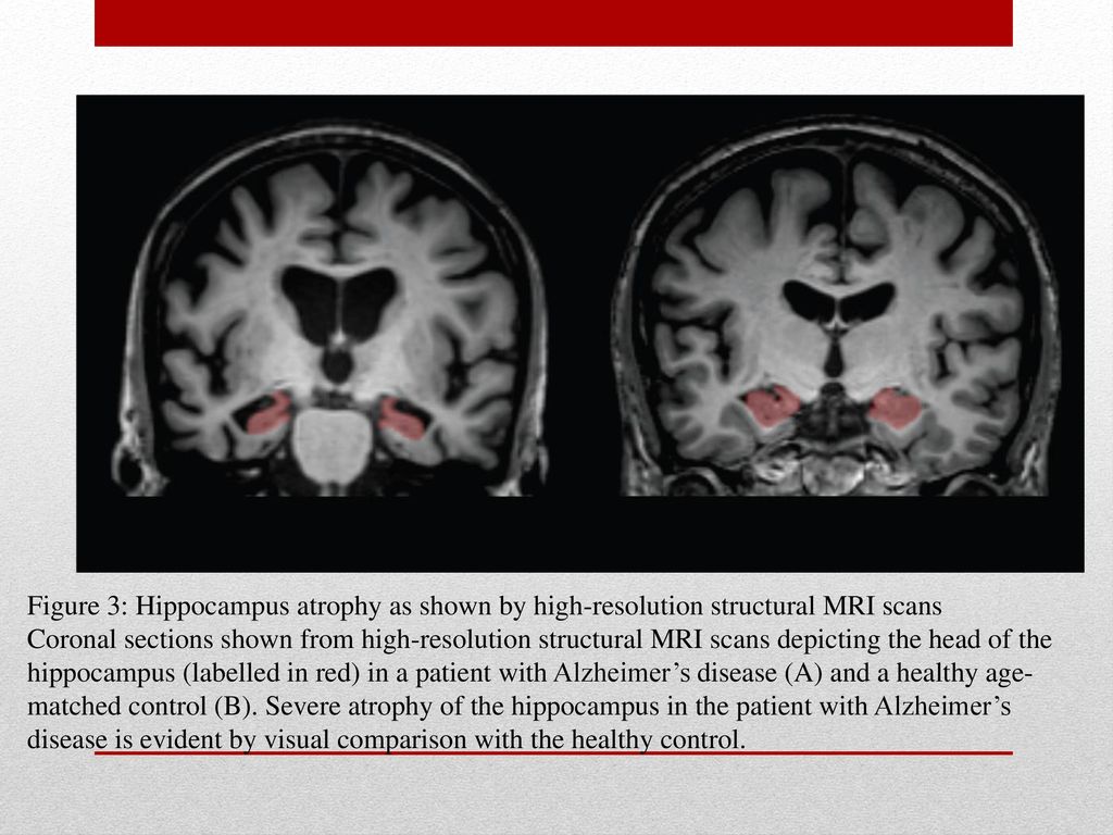 Figure 3: Hippocampus atrophy as shown by high-resolution structural MRI scans