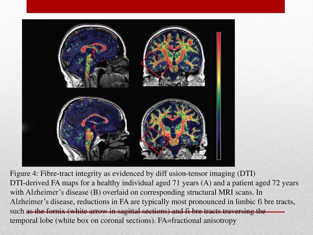 Figure 4: Fibre-tract integrity as evidenced by diff usion-tensor imaging (DTI)