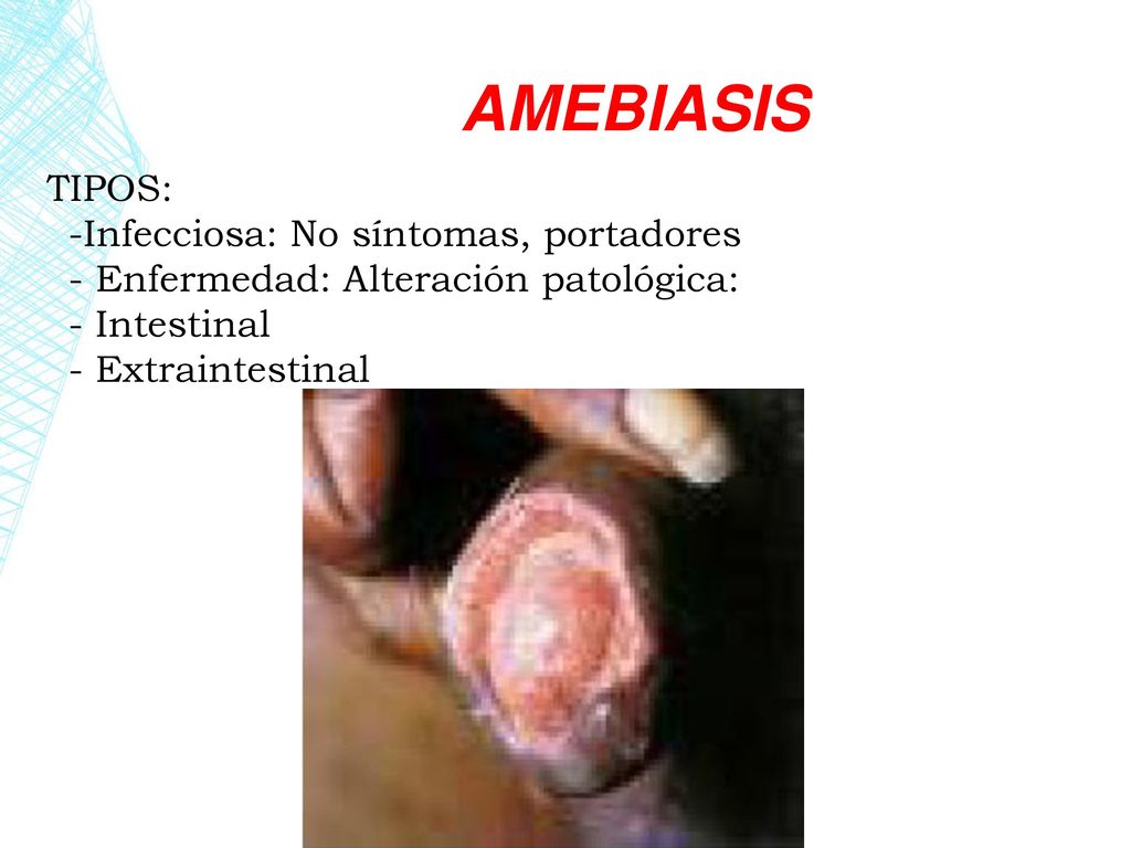AMEBIASIS TIPOS: -Infecciosa: No síntomas, portadores