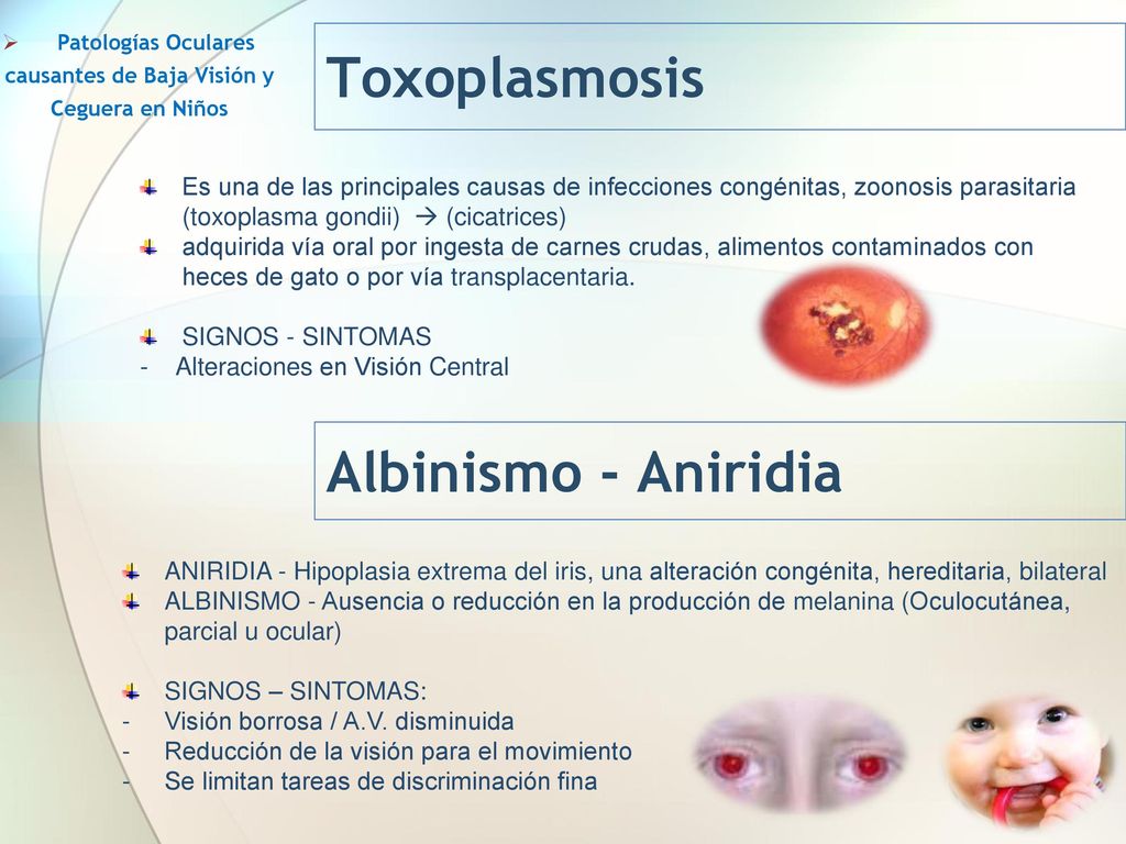 Patologías Oculares causantes de Baja Visión y Ceguera en Niños