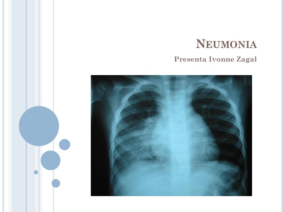 Neumonia Presenta Ivonne Zagal