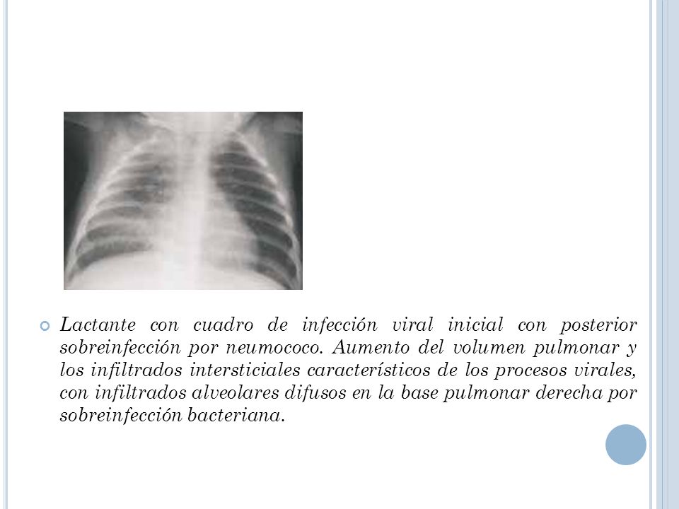 Lactante con cuadro de infección viral inicial con posterior sobreinfección por neumococo.