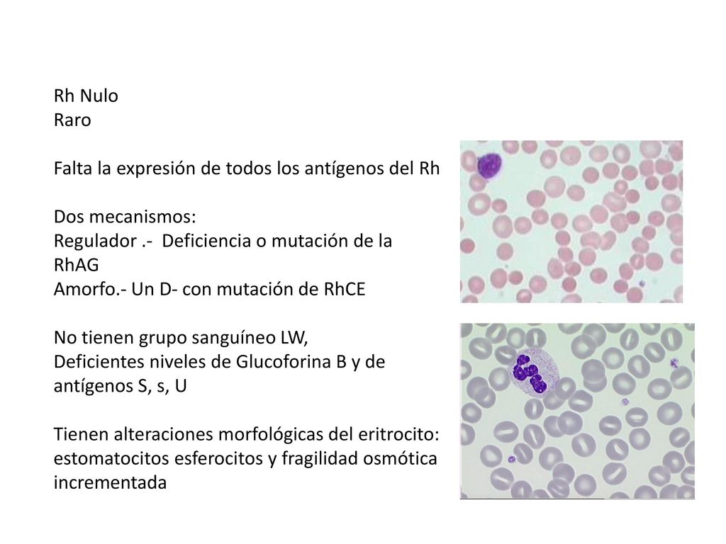 Rh Nulo Raro. Falta la expresión de todos los antígenos del Rh. Dos mecanismos: Regulador .- Deficiencia o mutación de la RhAG.