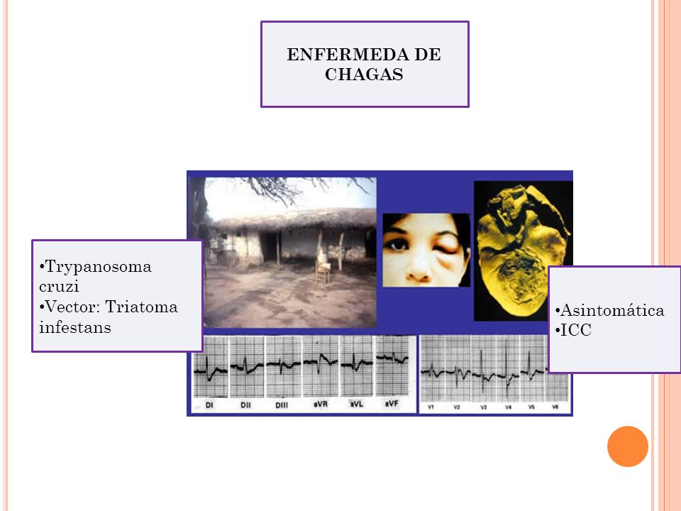 ENFERMEDA DE CHAGAS Trypanosoma cruzi Vector: Triatoma infestans Asintomática ICC