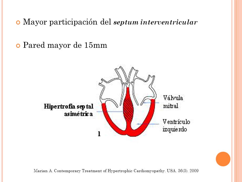 Mayor participación del septum interventricular Pared mayor de 15mm