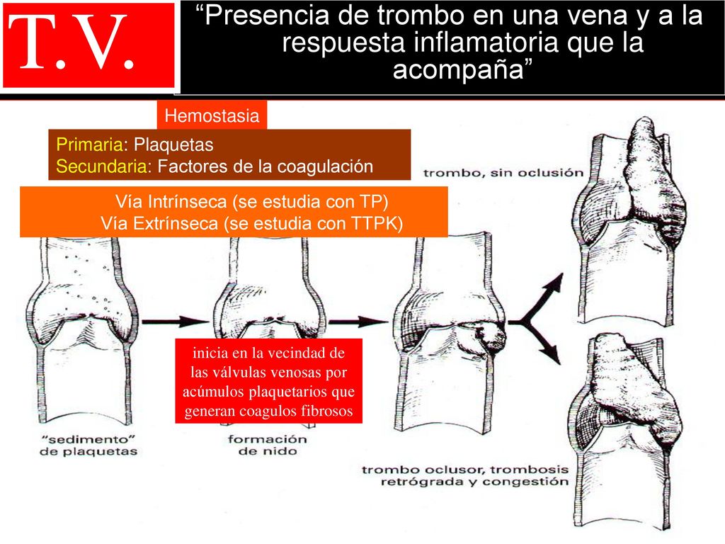 T.V. Presencia de trombo en una vena y a la respuesta inflamatoria que la acompaña Hemostasia. Primaria: Plaquetas.