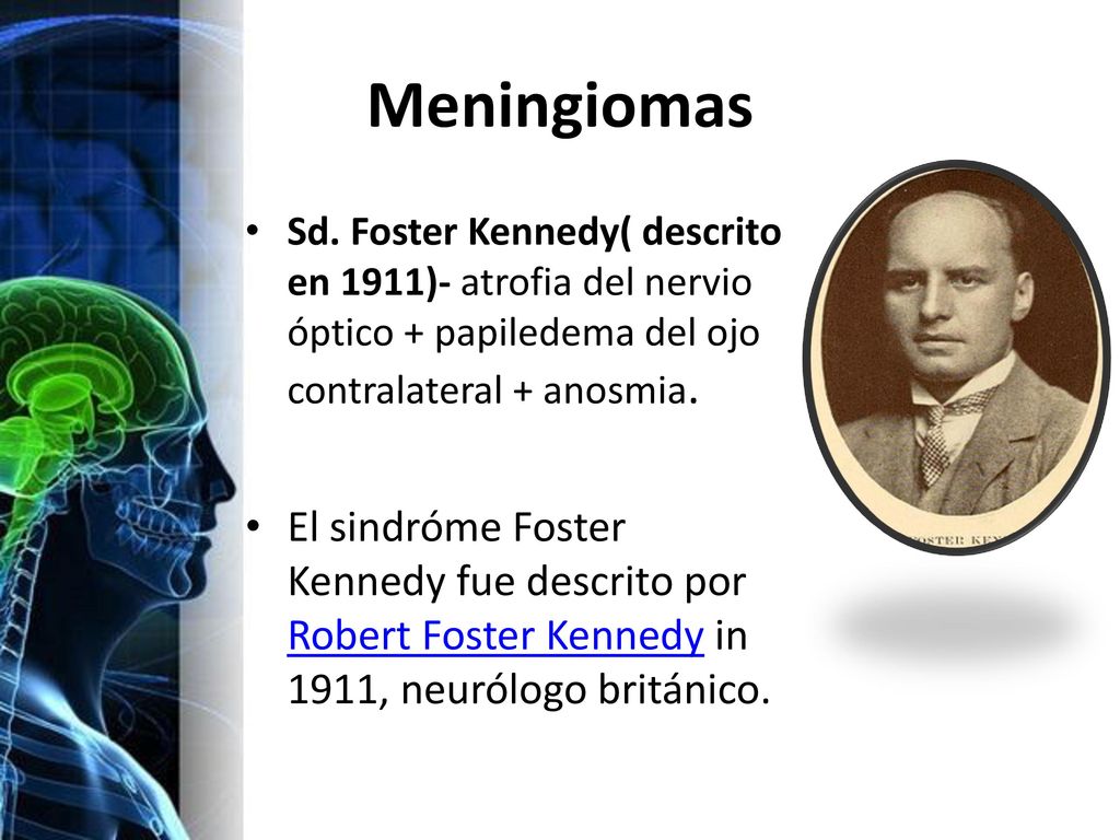 Meningiomas Sd. Foster Kennedy( descrito en 1911)- atrofia del nervio óptico + papiledema del ojo contralateral + anosmia.