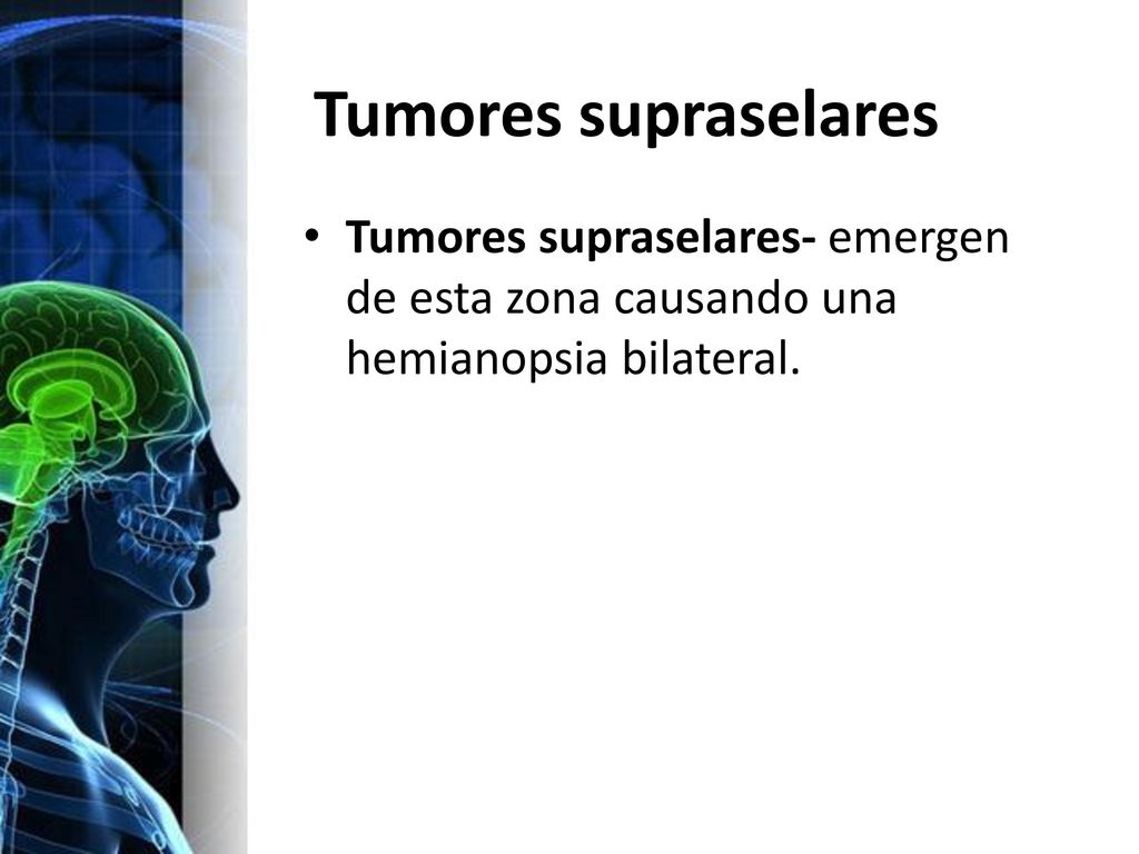 Tumores supraselares Tumores supraselares- emergen de esta zona causando una hemianopsia bilateral.