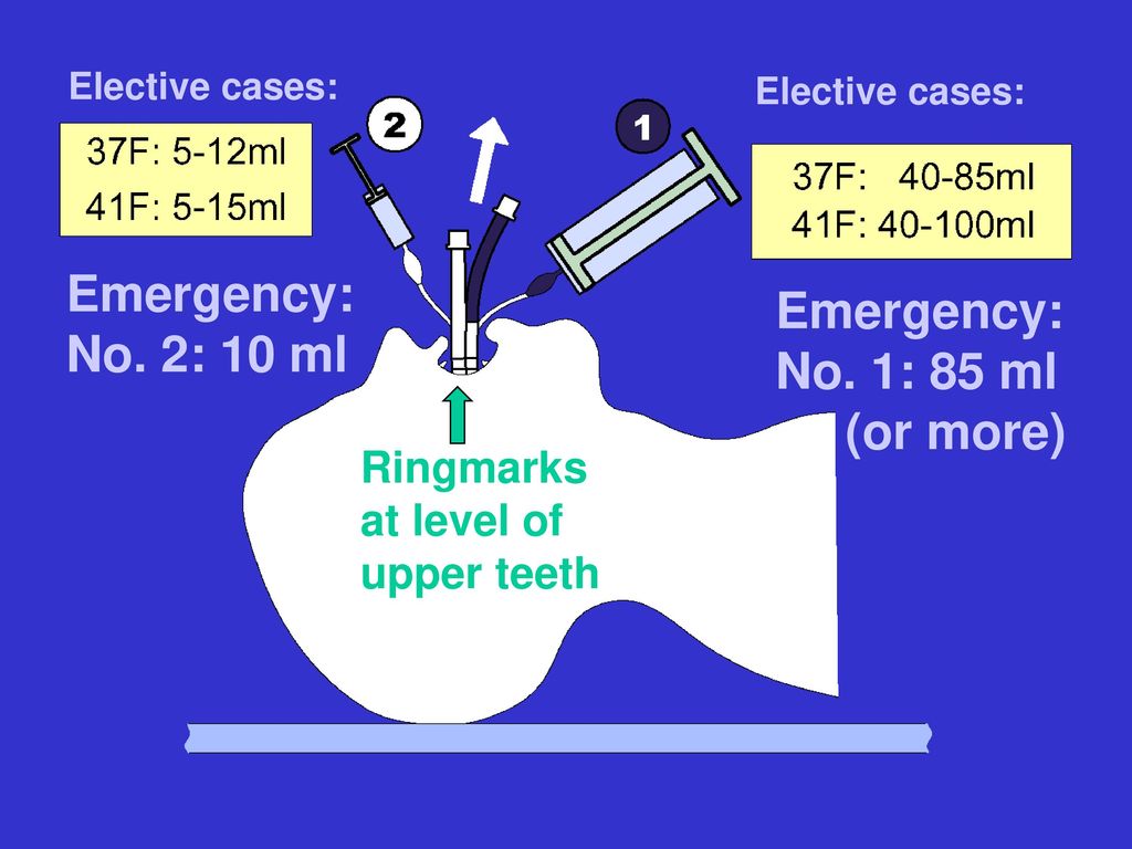 Emergency: Emergency: No. 2: 10 ml No. 1: 85 ml (or more) Ringmarks