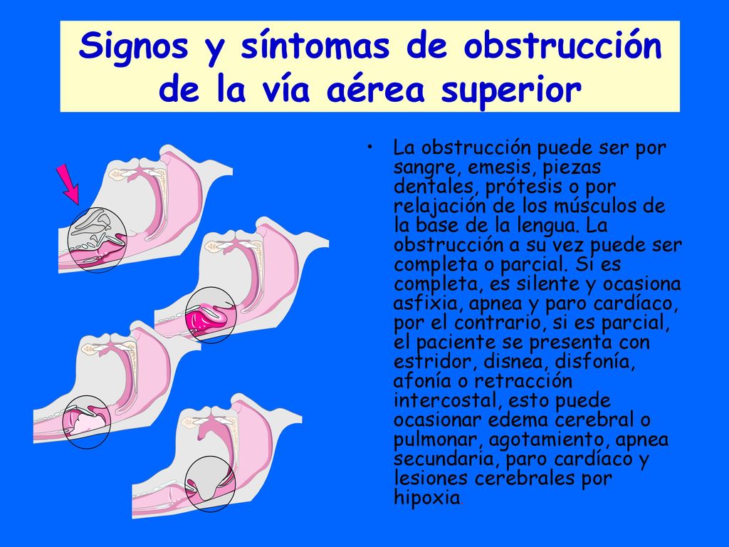 Signos y síntomas de obstrucción de la vía aérea superior