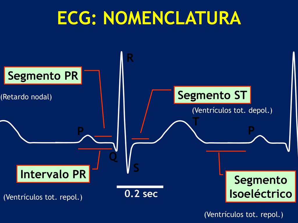 ECG: NOMENCLATURA R Segmento PR Segmento ST T P P Q S Intervalo PR