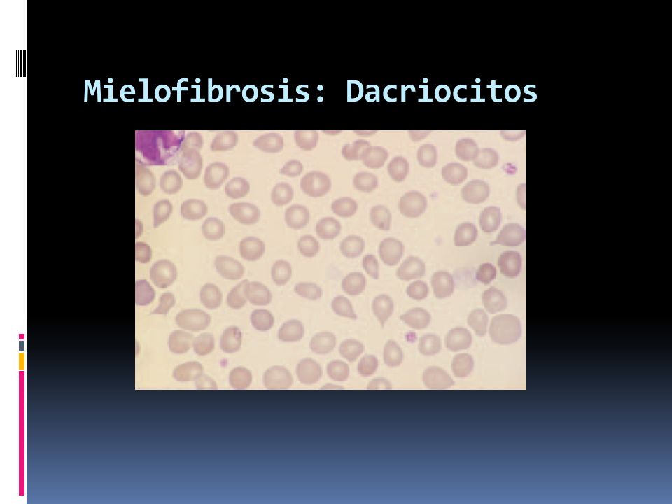 Mielofibrosis: Dacriocitos