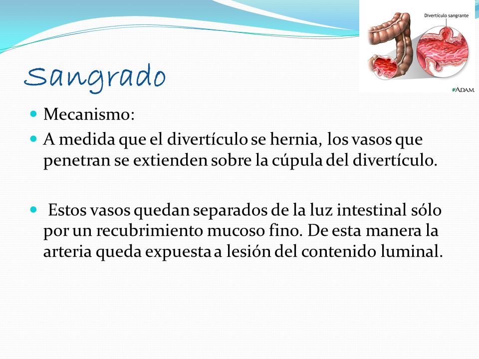 Sangrado Mecanismo: A medida que el divertículo se hernia, los vasos que penetran se extienden sobre la cúpula del divertículo.