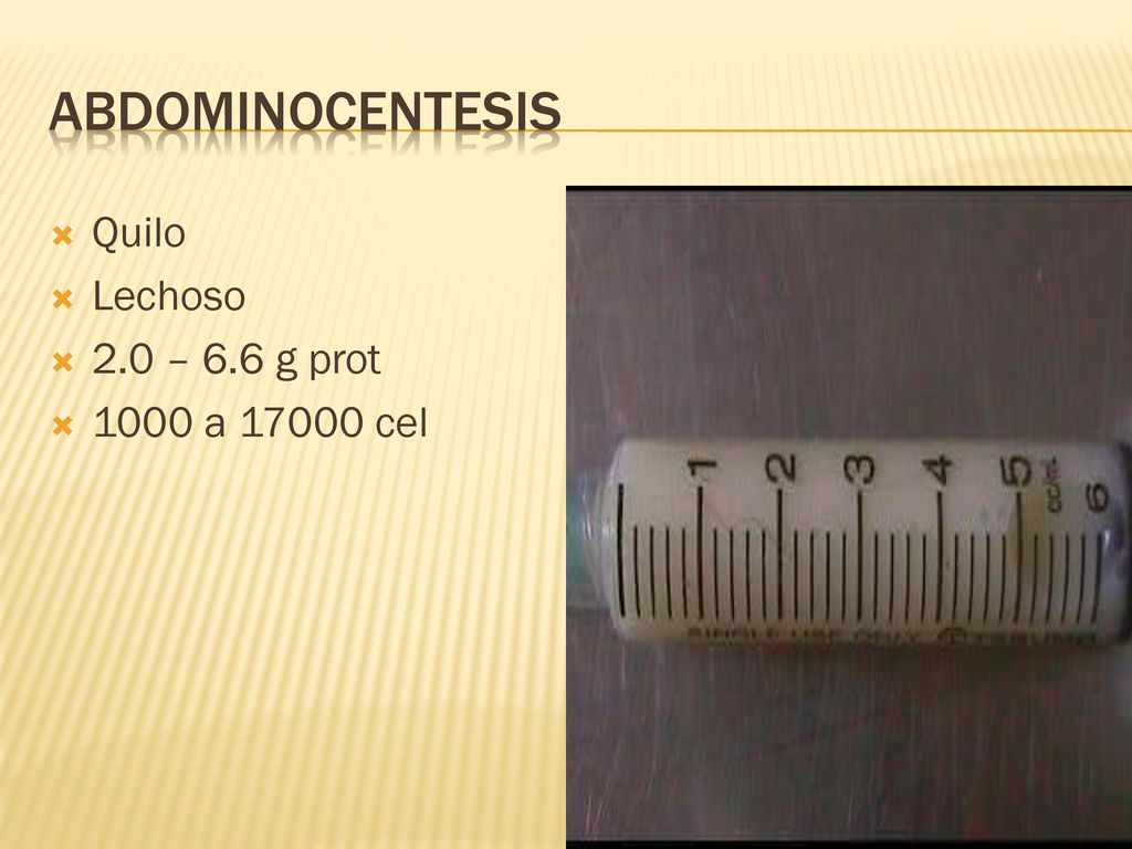Abdominocentesis Quilo Lechoso 2.0 – 6.6 g prot 1000 a cel