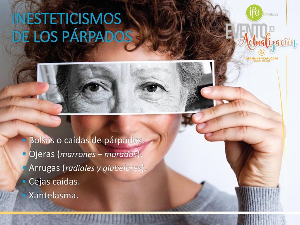 INESTETICISMOS DE LOS PÁRPADOS • Bolsas o caídas de párpados.
